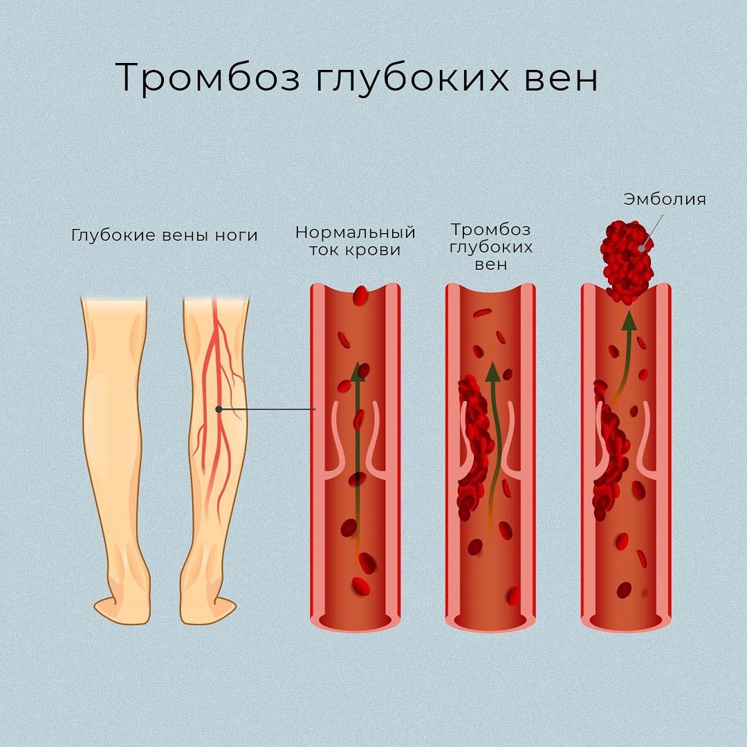 Развития тромбов. Нарушение свертываемости крови. Формирования тромба на месте раны.